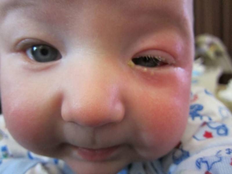 11 способів лікування опухлих очей у дітей у домашніх умовах