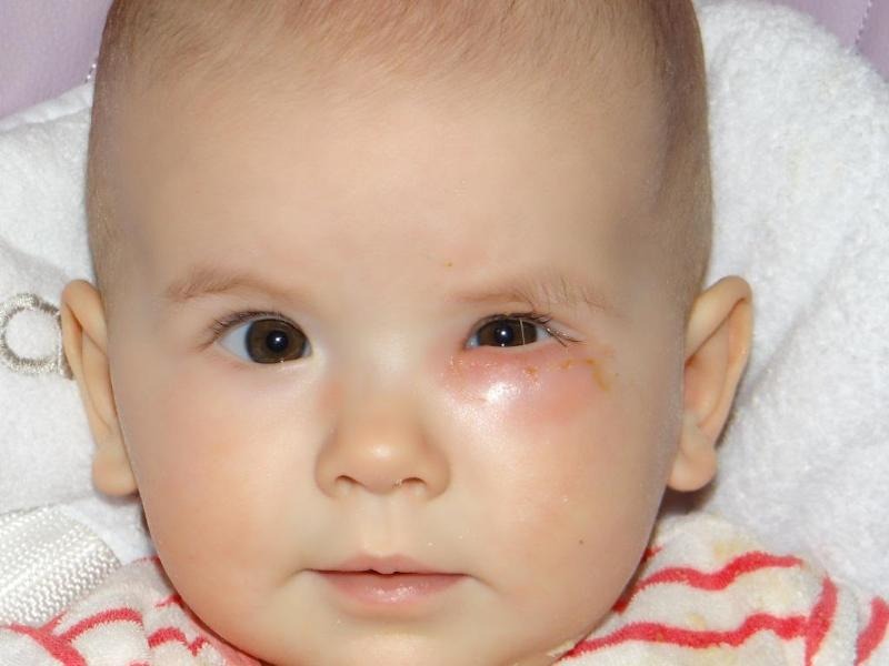 11 способів лікування опухлих очей у дітей у домашніх умовах